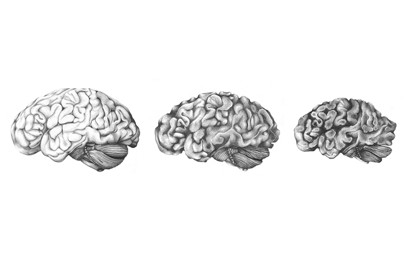 Illustrasjon av hjernens ulike stadier av demensutvikling. Bildet til venstre viser en normal hjerne. På bildet i midten ser vi en hjerne som er i en demensutviklingsfase og som er i ferd med tape hjernebark illustrert ved furene mellom hjernevinningene blir dypere og bredere. Bildet til høyre illustrerer tap av store deler av hjernemassen som ved langt framskredet demenssykdom.